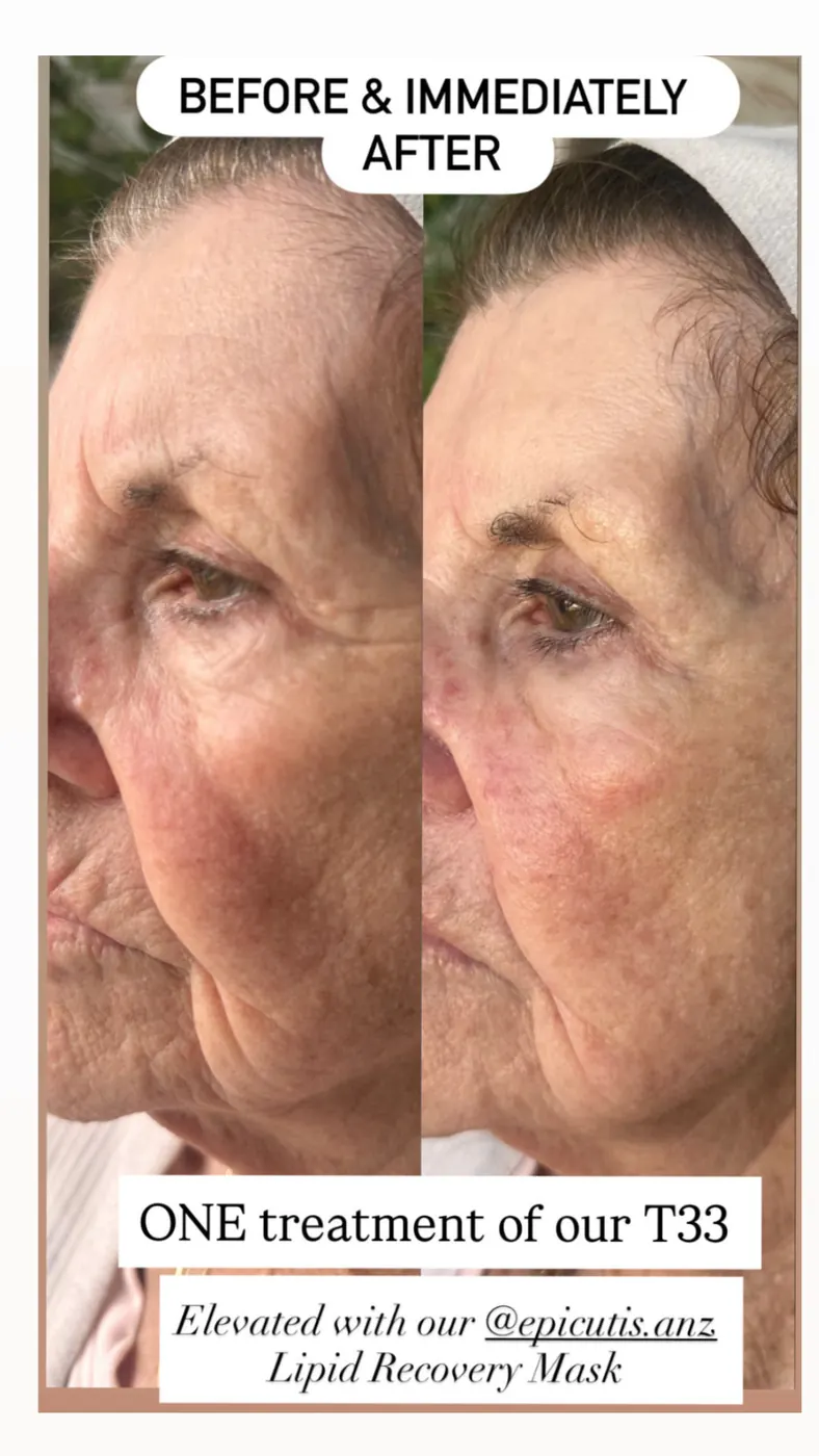 87-year-old T33 client before and after her first treatment