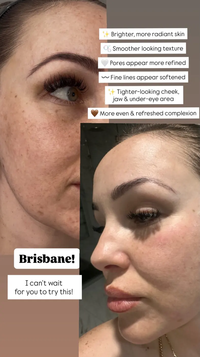 T33 client skin progress photographs