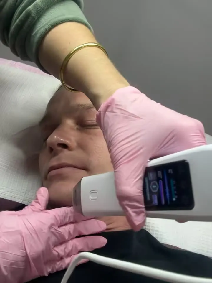 Ultra Cold Jet T33 treatment being performed at Easey Aesthetics
