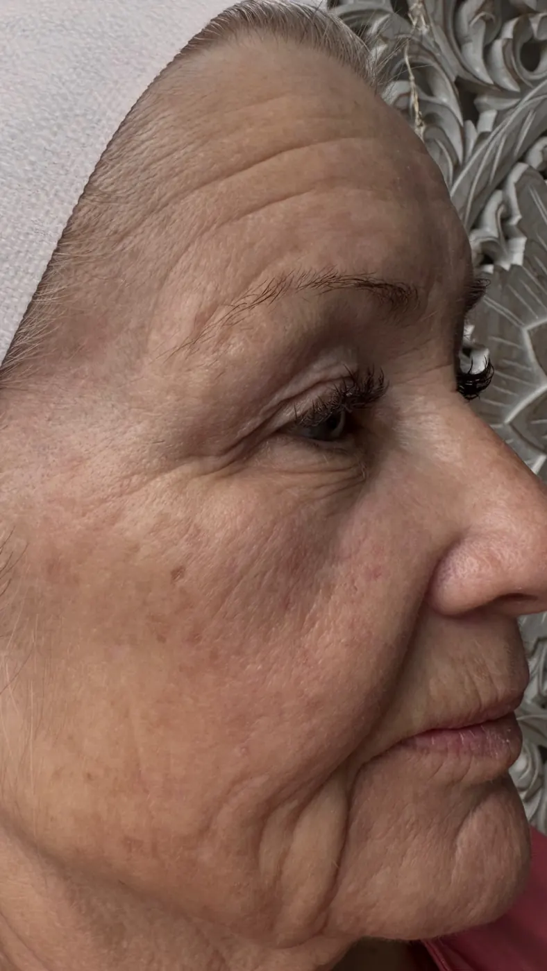Client right profile before T33 treatment