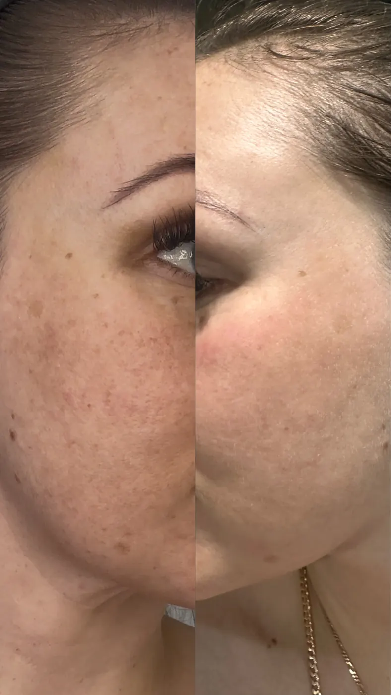 T33 client cheek texture comparison photographs