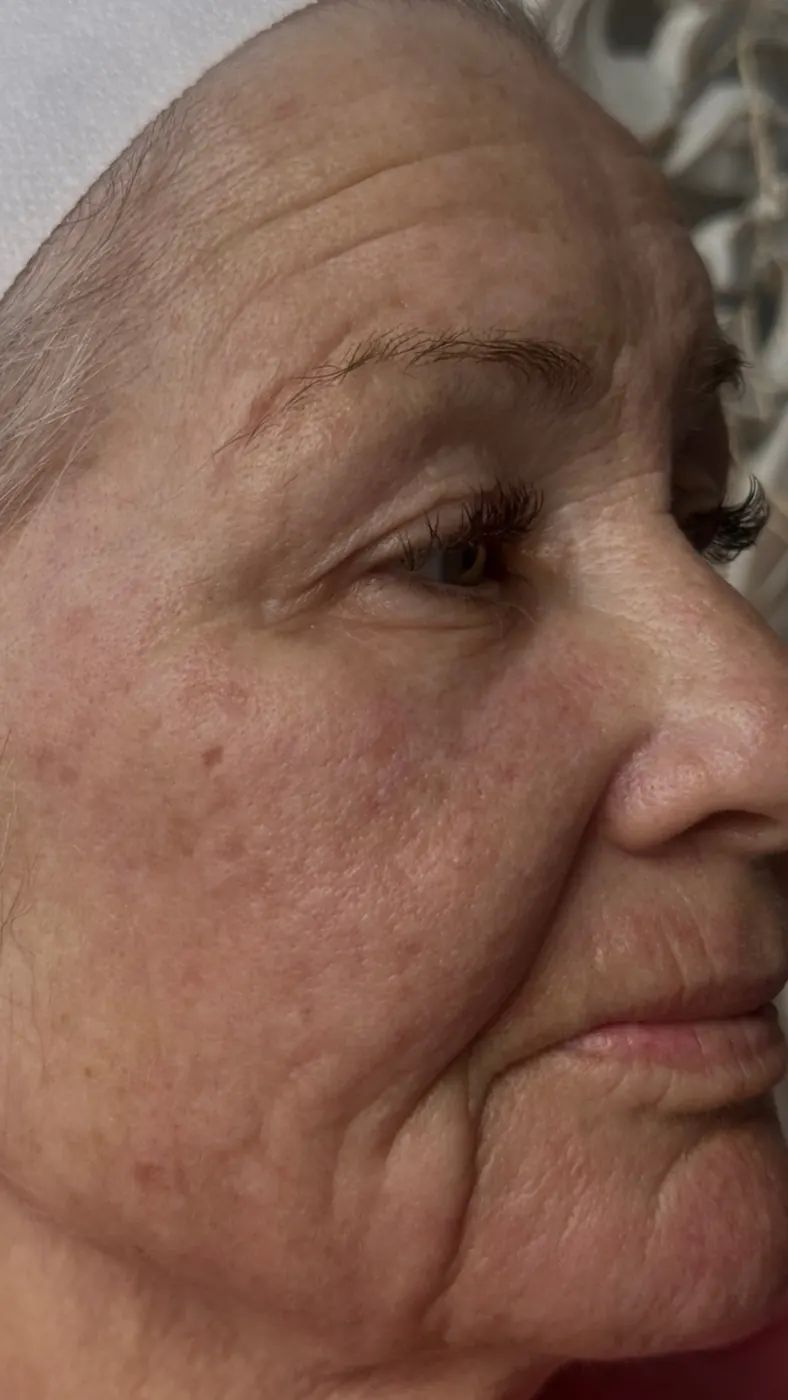 Client right profile after her first T33 treatment