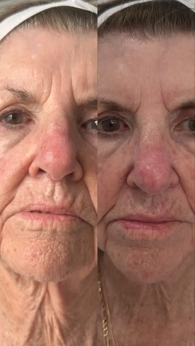 87-year-old T33 client front view before and after her first treatment