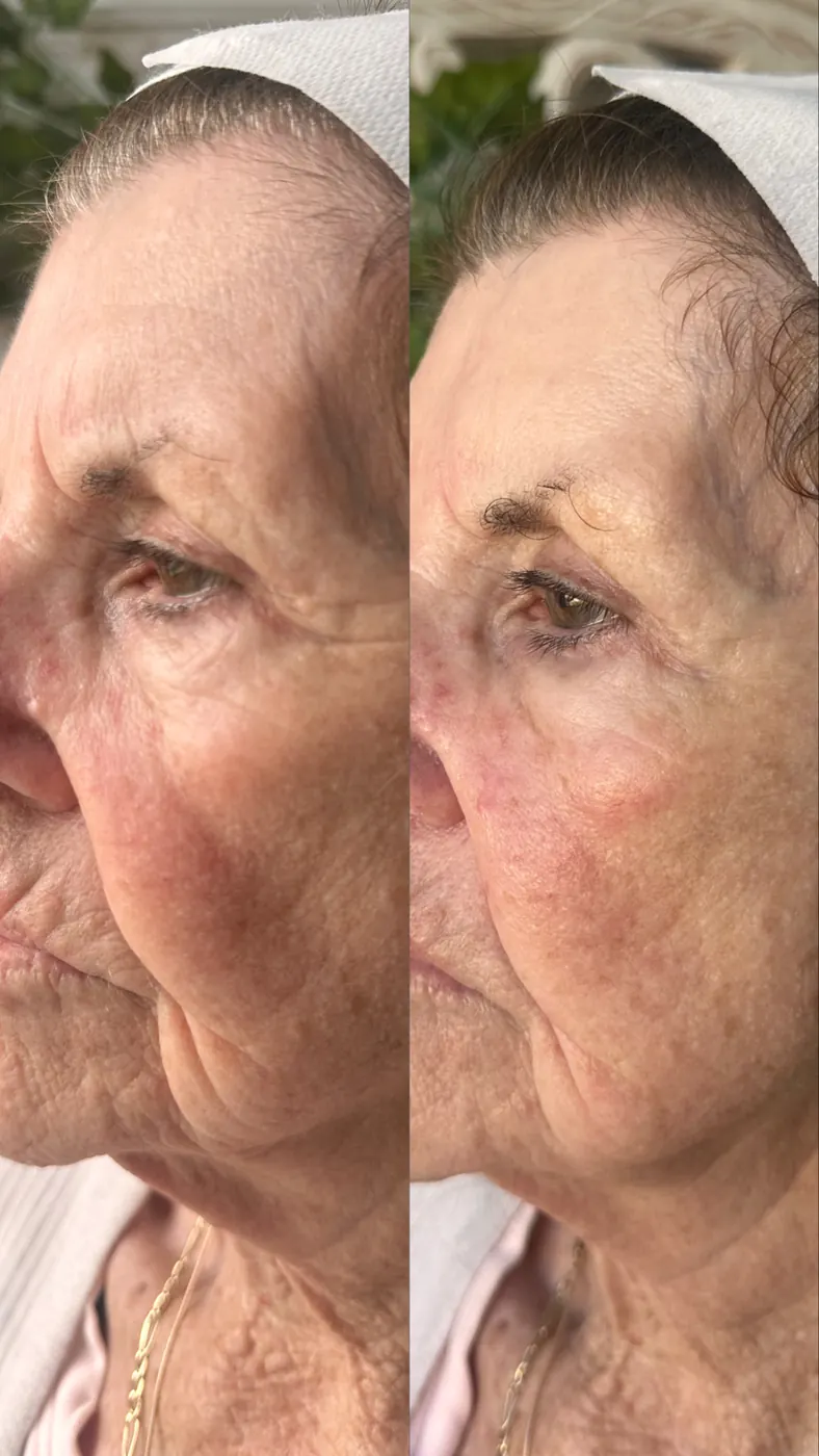 87-year-old T33 client profile before and after her first treatment