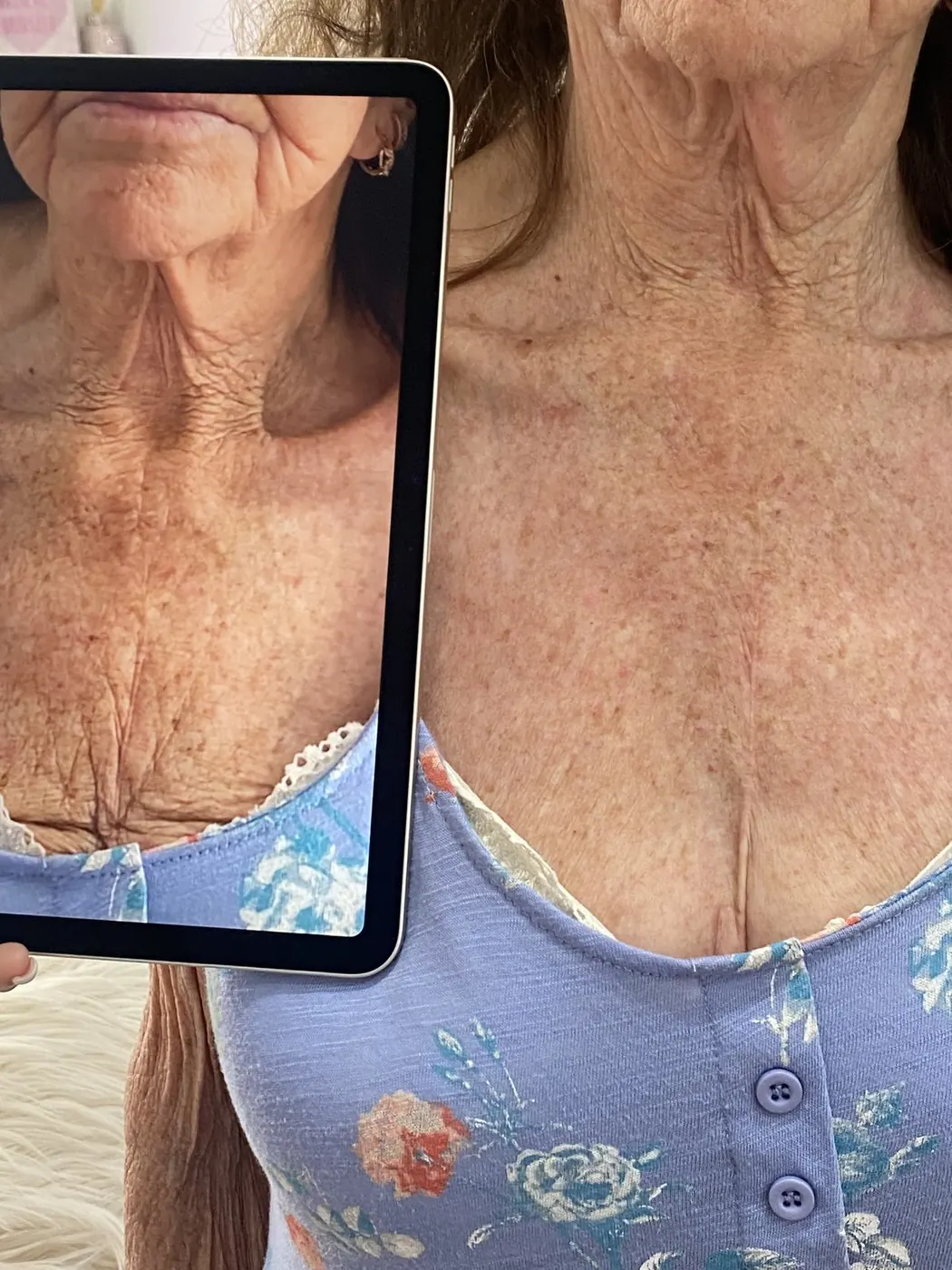 Before and after of a client's décolletage following T33 treatment