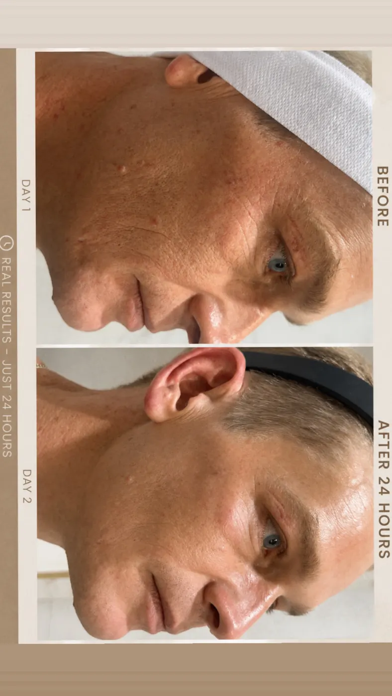 T33 client before treatment and 24 hours after